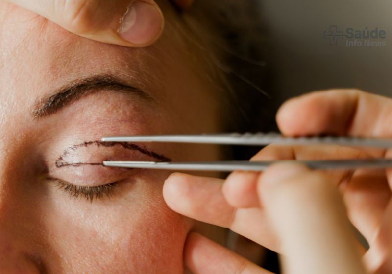 Blefaroplastia Palpebra Superior Antes E Depois
